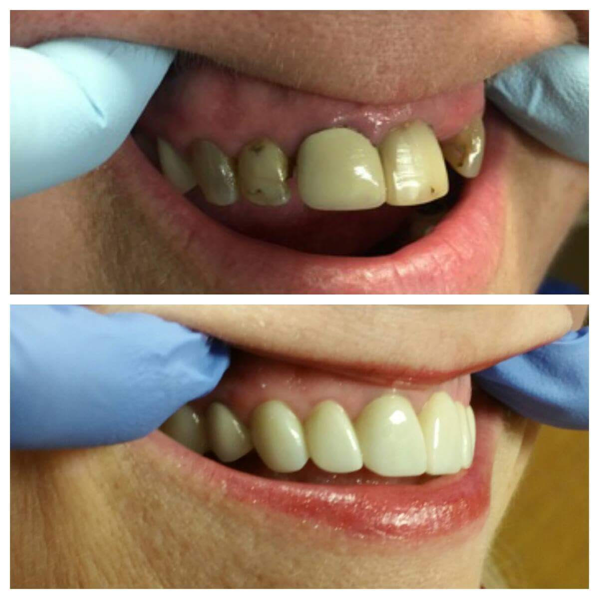 image of woman with dental crown
